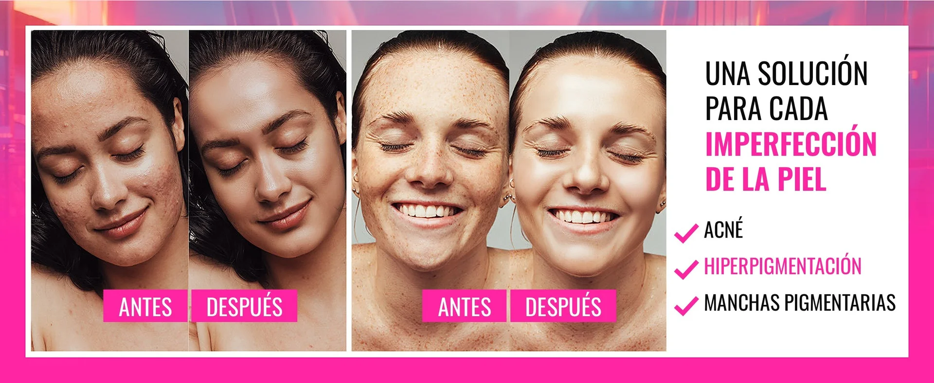 A solution for every skin imperfection: acne, hyperpigmentation, pigment spots - before and after photos